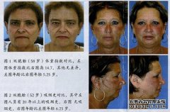 外在因素影响面部衰老 外在因素影响面部衰老