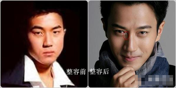 刘恺威假面小生整形记-三元整形网