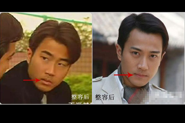 刘恺威假面小生整形记-三元整形网