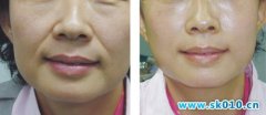 神奇的童颜术——韩式小切口除皱术