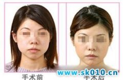 北京华韩面部抽脂降低风险吗