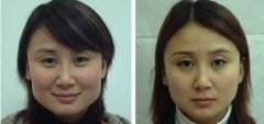 <b>广州曙光美容整形院张元龙下颌角整形适合哪些情况做？</b>