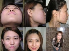 <b>方下巴矫正+隆鼻+额头整形手术后记~~</b> <b>方下巴矫正+隆鼻+额头整形手术后记~~</b>