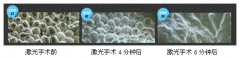 Super HPL溶脂瘦大腿
