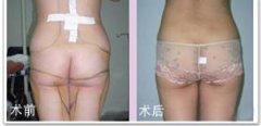 <b>臀部吸脂对比图</b>