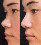 <b>上海九院隆鼻做的好不好呢?</b> <b>上海九院隆鼻做的好不好呢?</b>