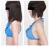 <b>上海九院做自体脂肪丰胸怎么样呢?</b>