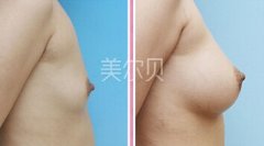 <b>上海九院自体脂肪丰胸后该如何护理呢?</b>