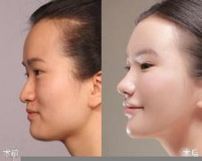 上海九院隆鼻手术后感染了该怎么办?