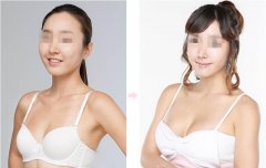 上海九院胸部整形要多少钱?