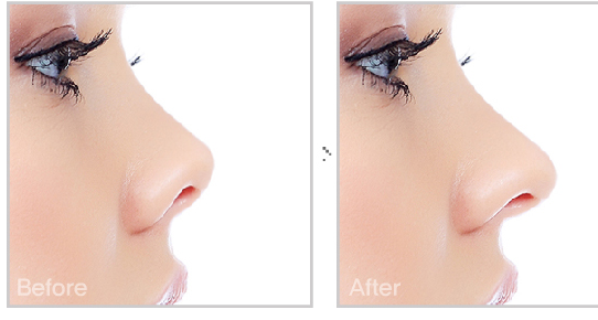 成都取出隆鼻假体后还能恢复自然吗