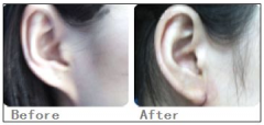 <b>四川美莱自体脂肪丰耳垂的优势是什么?</b>
