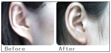 四川美莱自体脂肪丰耳垂的优势是什么