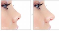 <b>四川隆鼻假体取出降低风险吗?</b> <b>四川隆鼻假体取出降低风险吗?</b>