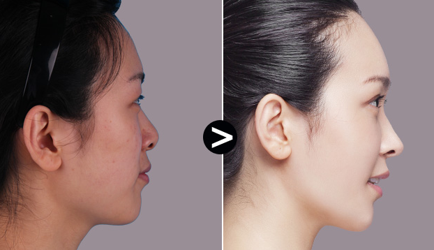 四川隆鼻假体取出会不会留下后遗症