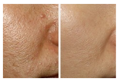 四川缩小毛孔有的方法是什么