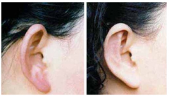 <b>四川常见的丰耳垂的方式有几种?</b>