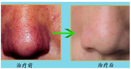 四川缓解酒糟鼻的方法有哪些