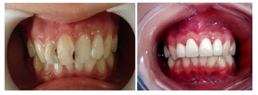 四川做烤瓷牙的价格贵吗