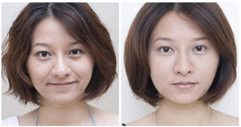 四川射频除皱术后该怎么护理