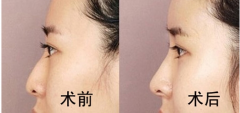 四川做驼峰鼻矫正术的比较好时机?