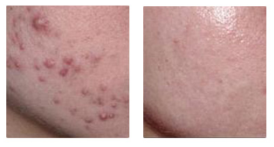 四川激光缓解痤疮有什么优势