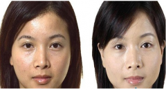 四川光子嫩肤收缩毛孔多久见?