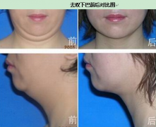 <b>四川减掉双下巴的方法有几种?</b>