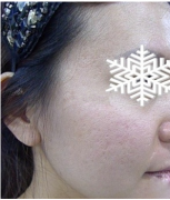 光子嫩肤后皮肤水嫩水嫩的