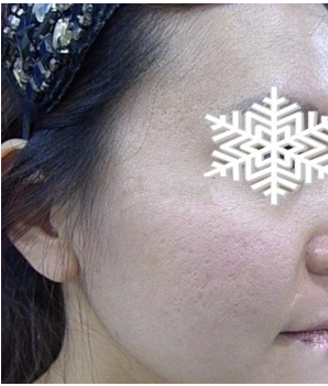 光子嫩肤后皮肤水嫩水嫩的