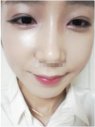 <b>终于去除了难看的眼袋</b>