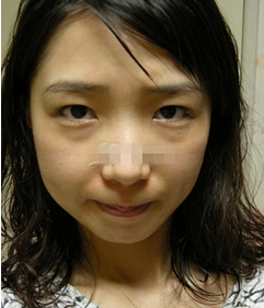 终于去除了难看的眼袋