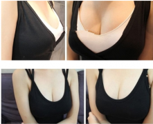 <b>隆胸是我Z不后悔的决定</b>