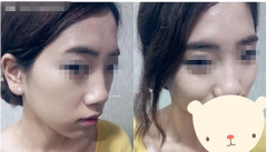 <b>丰面颊后整个人看起来都精神好多</b>