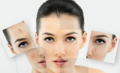 四川E光嫩肤祛痘有什么优势?