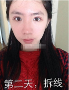 <b>双眼皮手术后都说好惊喜</b>
