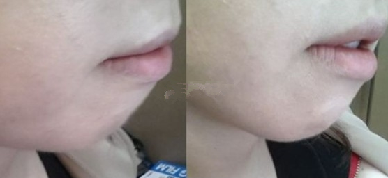 隆下巴后气质多了
