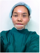 <b>假体垫下巴,果很不错哦</b> <b>假体垫下巴,果很不错哦</b>