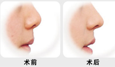 假体隆鼻多少钱,假体隆鼻需要多少钱