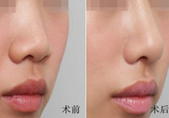 <b>什么是玻尿酸?玻尿酸隆鼻多少钱?</b>