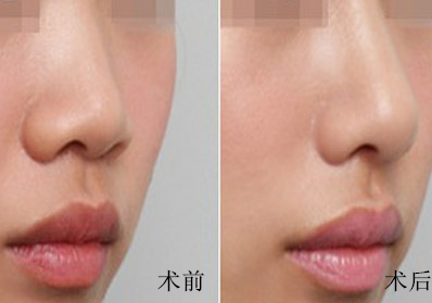 什么是玻尿酸,玻尿酸隆鼻多少钱