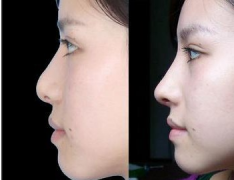 <b>膨体隆鼻价格?膨体隆鼻有什么优势?</b> <b>膨体隆鼻价格?膨体隆鼻有什么优势?</b>