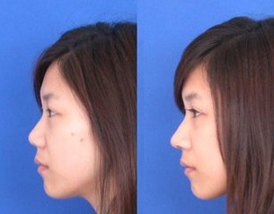 假体隆鼻能保持多久?假体隆鼻后注意事项?