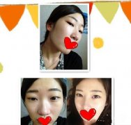 一个美女的缝线双眼皮&假体隆鼻的案例 一个美女的缝线双眼皮&假体隆鼻的案例