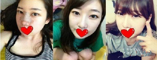 一个美女的缝线双眼皮&假体隆鼻的案例