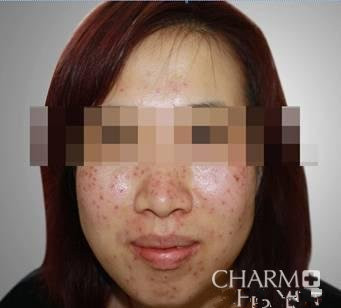 激光去雀斑塑造了一个更**的我