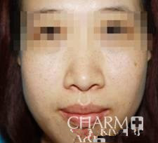 激光去雀斑塑造了一个更**的我