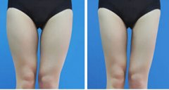 大腿吸脂整形手术,让你轻松拥有纤细美腿 大腿吸脂整形手术,让你轻松拥有纤细美腿