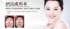 酒窝再造术后多久能恢复 酒窝再造术后多久能恢复