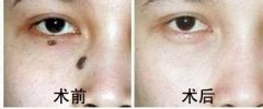 激光去痣有哪些优势